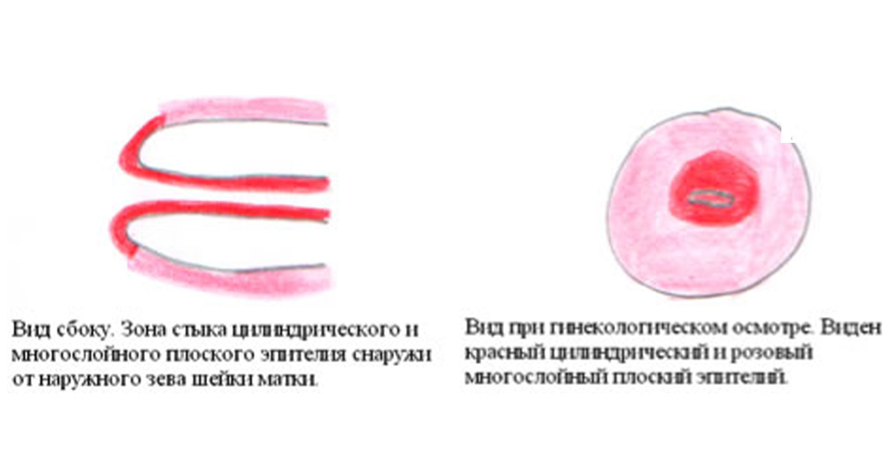 Шейка матки конической формы. Цилиндрический эпителий шейки матки. Плоский и цилиндрический эпителий шейки матки. Цилиндрический эпителий шейка матки. Цилиндрическая форма шейки матки.